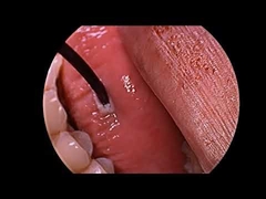 Generator Plasma Frekuensi Radio untuk Pengobatan Mendengkur dengan Probe Multi Fungsi