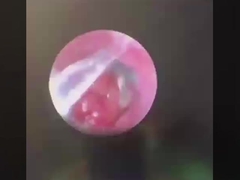 ButterFly ENT Instrumen Bedah ENT Probe