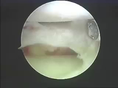 Instrumen Bedah Elektro Sistem Ablasi Produk Ablasi Untuk Tulang Belakang Dan Sendi