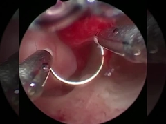 Teknologi Dingin Plasma Bedah Elektrod Untuk Urologi Prosedur BPH