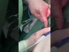 Probe Hepatologi Klinik PLA408 untuk Operasi Terbuka